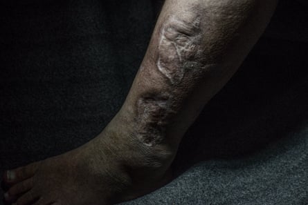 A badly scarred ankle