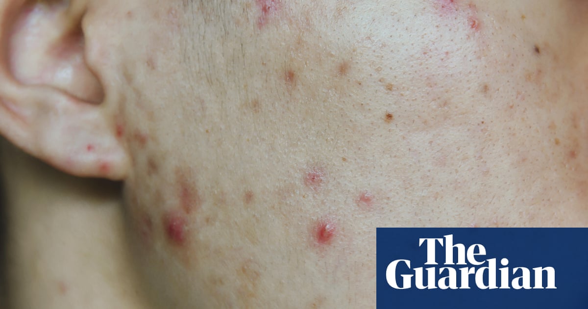 Nice recommends mental health support for those badly affected by acne