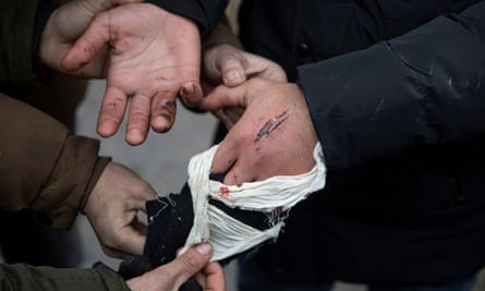 An injured migrant shows wounds he said were caused by Hungarian police, 28 January 2020.