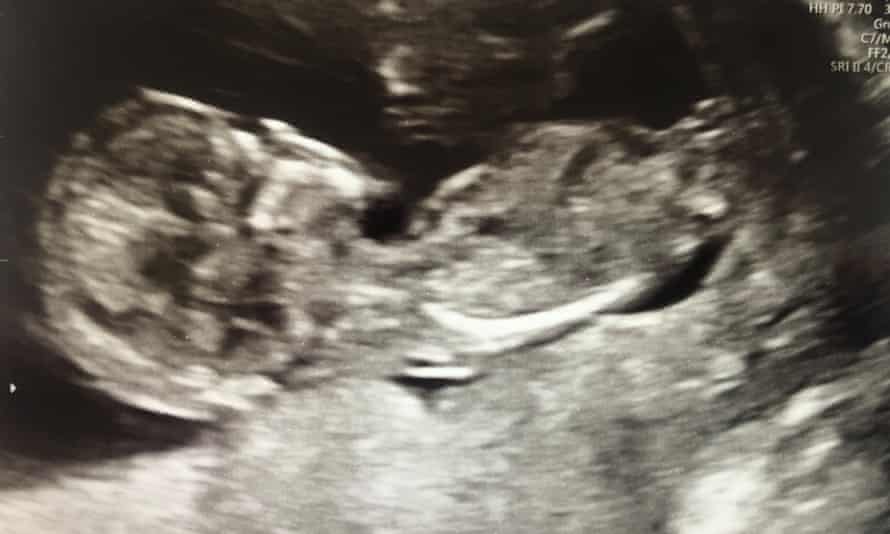 Growing fast: the baby in her 12-week scan picture