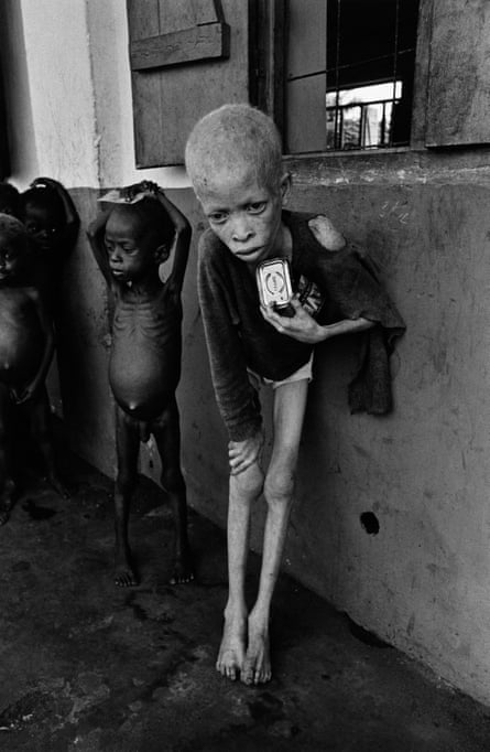 A starving albino boy, harassed and discriminated against by his own people for the colour of his skin, clutches an empty corned beef tin at an orphanage Biafra, 1969