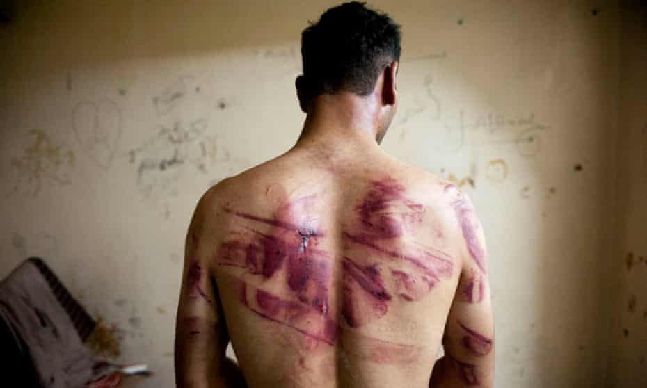 A man shows the wounds on his back.