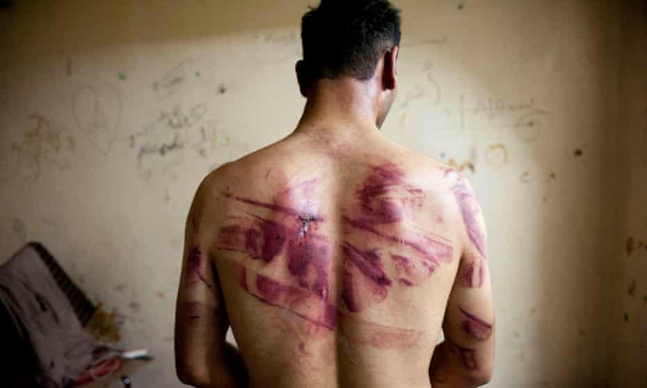 A Syrian man shows marks of torture on his back after he was released from regime forces in Aleppo in 2012.