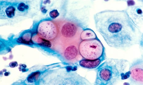In 2016 there were more than 417,000 diagnoses of sexually transmitted infections in England, including gonorrhoea and chlamydia (pictured).