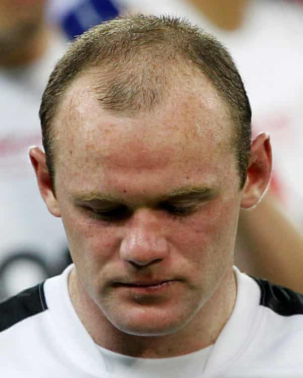 Widow's peak: Wayne Rooney before his £30,000 follicular unit extraction.