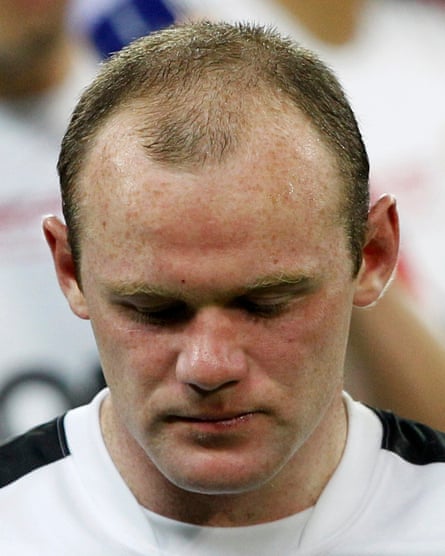 Widow’s peak: Wayne Rooney before his £30,000 follicular unit extraction.