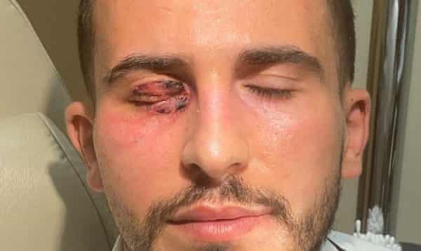 Omar Elabdellaoui’s right eye after the lid reconstruction.