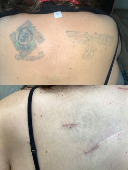 Before and after of tattoo removal