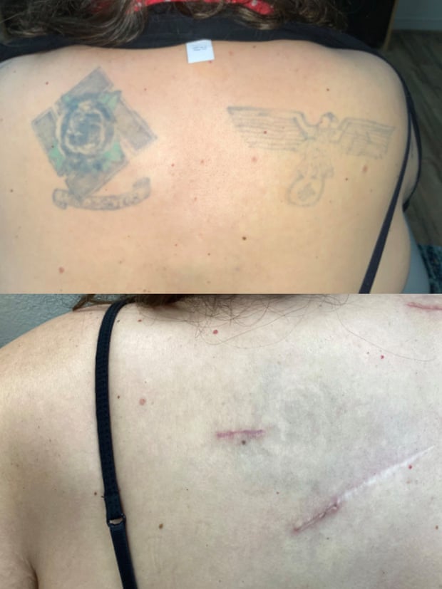 Before and after of tattoo removal done by Removery. Composite: Removery