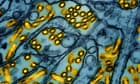 First person in US to develop severe illness from bird flu is hospitalized