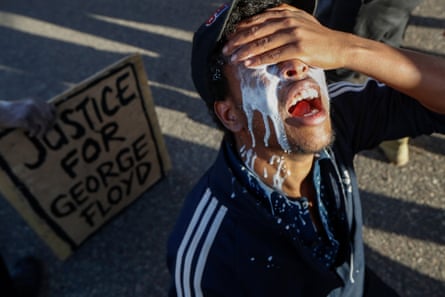 Man holds his eyes while a sodium bicarbonate mixture drips down his face