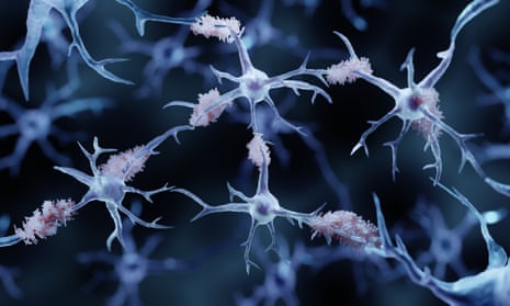 Amyloid plaque, the toxic protein in the brain linked to the cognitive disease.