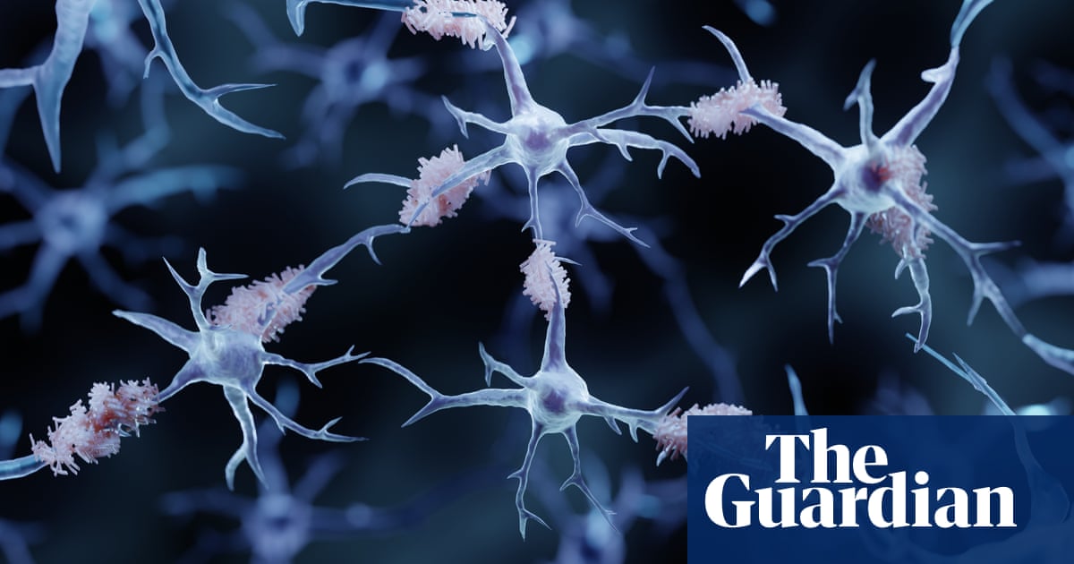 Scientists develop blood test for Alzheimer’s disease - The Guardian