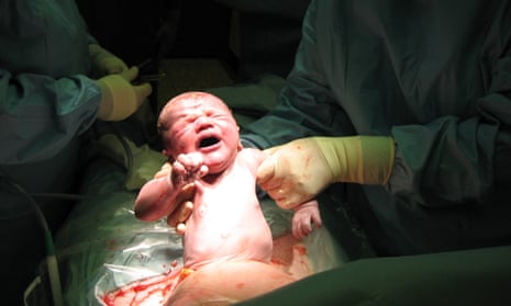 Baby being born via caesarean section.