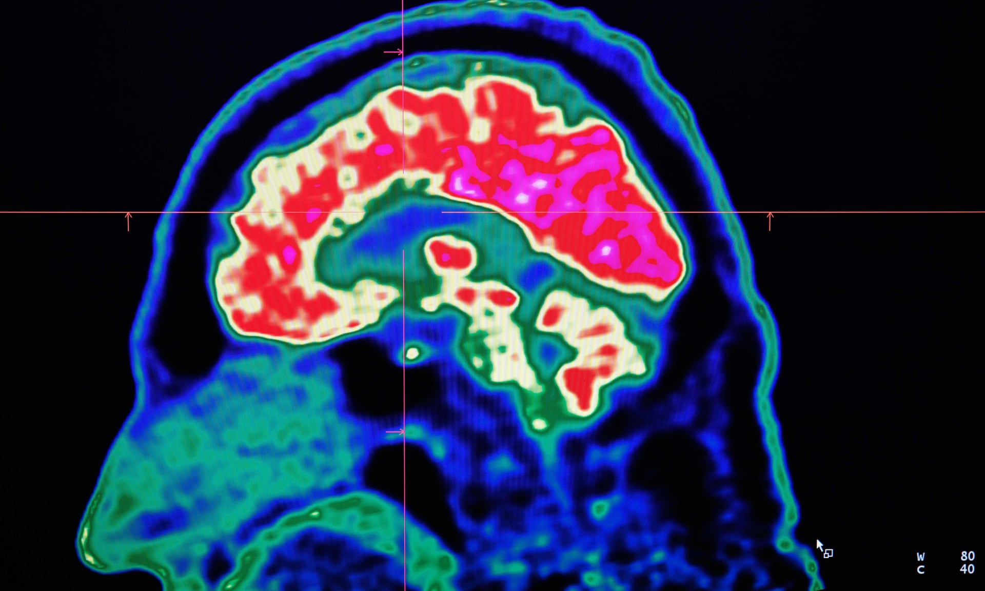 Exercise helps brain deal with Lewy Body Dementia pathologies Exercise helps brain deal with Lewy Body Dementia pathologies
