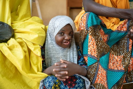 A smiling girl with facial scarring