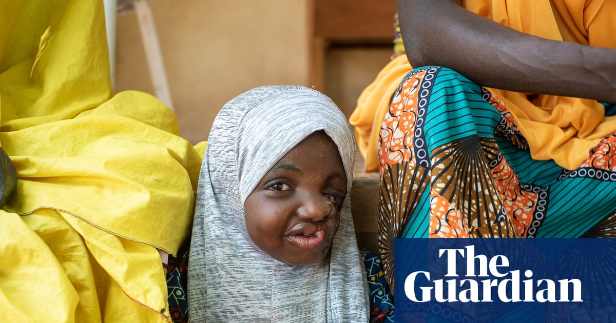 ‘Astonishing’ discovery could help save children from deadly disfiguring condition