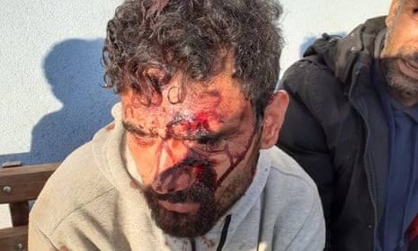 A refugee shows wounds allegedly inflicted by Croatian border forces.