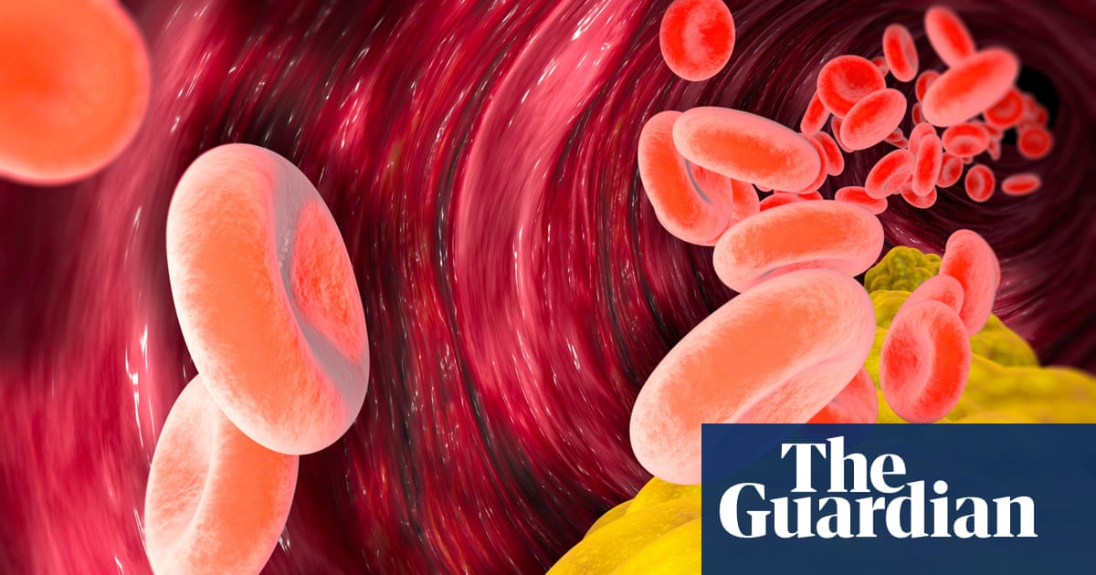 Lowering bad cholesterol may cut risk of dementia by 26%, study suggests