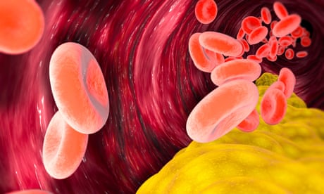 Illustration of plaque build-up in the arteries, with red blood cells