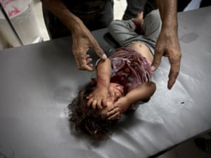An injured Palestinian toddler clutches her face on a hospital bed at Nasser hospital after Israeli forces attacked makeshift tents