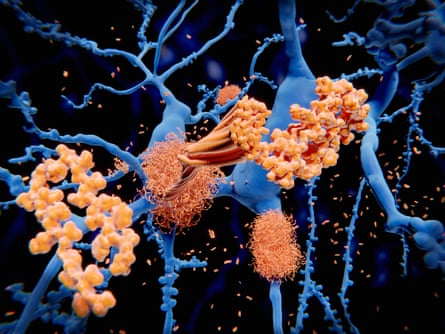 A rendering of amyloid, a protein that accumulates as plaques in the brain.