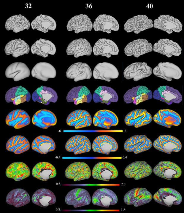 3D reconstruction of the cortical surface and calculated features from a seven-month, eight-month and nine-month baby brain MRI. From top to bottom: white matter surface, cortical surface, inflated surface, parcellation into different structures, sulcal depth maps, mean curvature, cortical thickness and T1/T2 myelin maps.