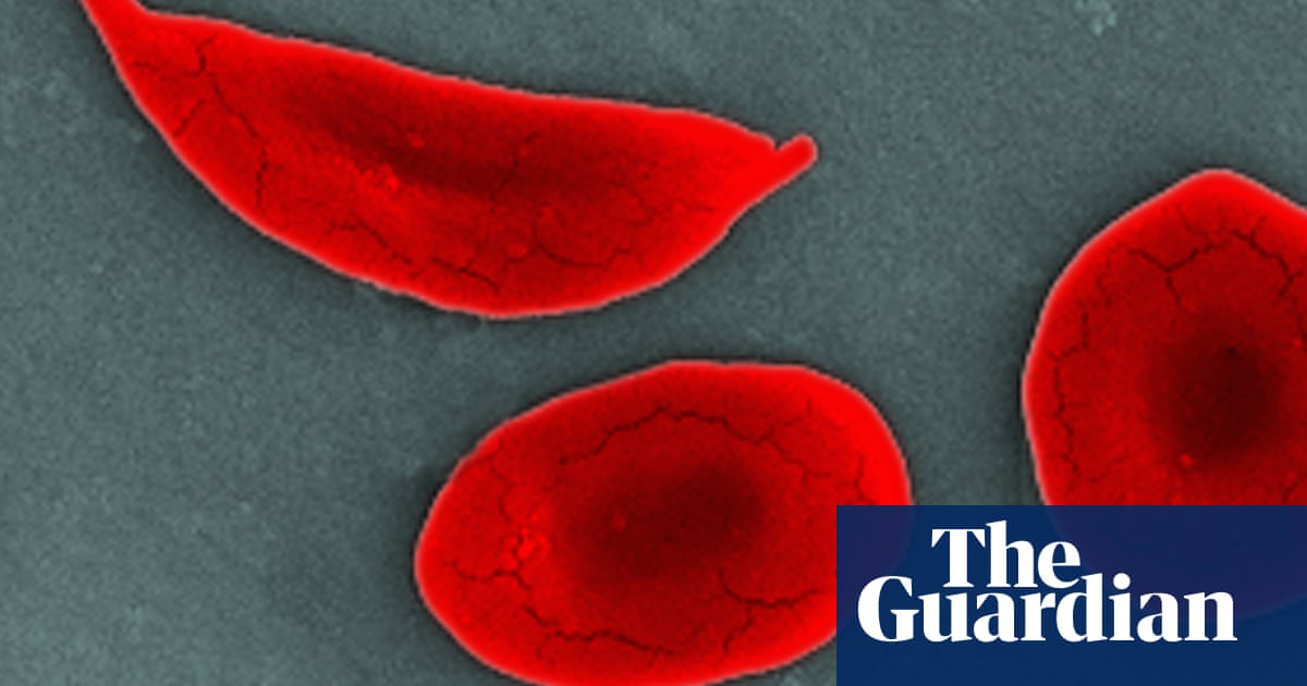 UK sickle cell patients get worse care than sufferers of similar disorders'