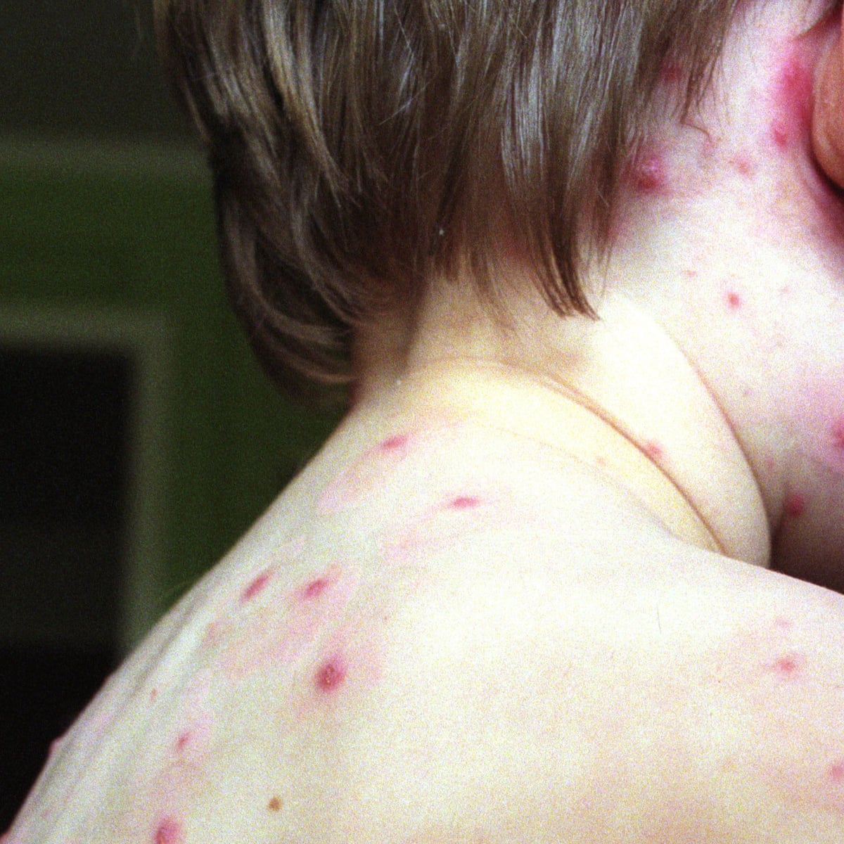 An Outbreak Of Chicken Pox Raises A Tricky Question Parents And Parenting The Guardian