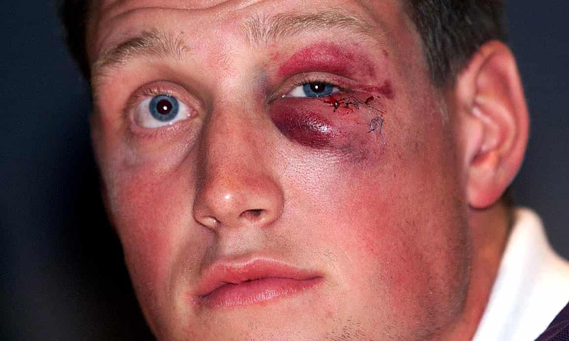 British and Irish Lions fly-half Ronan O’Gara reveals the full extent of his eye injury during a press conference in Australia.