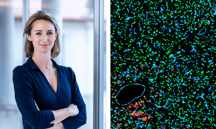 LEFT: Dr Charlotte Spencer RIGHT: Features of the tumour microenvironment (blood vessels and immune cells) are common targets for drug therapies. They can be characterised in depth using technology such a multiplex immunofluorescence as shown here in clear cell renal cell carcinoma (teal= blood vessels, red = CD8+ T lymphocytes, orange = CD4+ T lymphocytes, green = tumour cells).