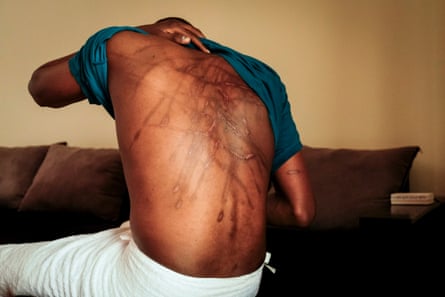 Kakwenza Rukirabashaija displays scars on his back. He claims they were inflicted by torture.