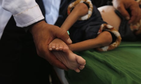 A Yemeni doctor treats a malnourished child at a hospital.