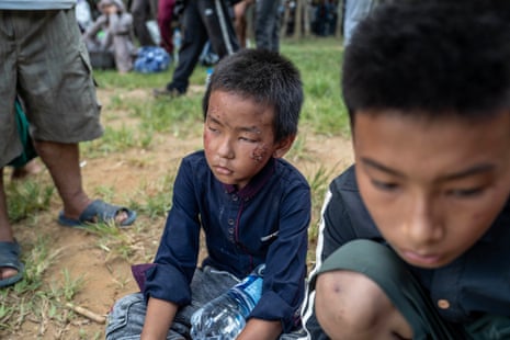 Two young boys, one with a scratched face