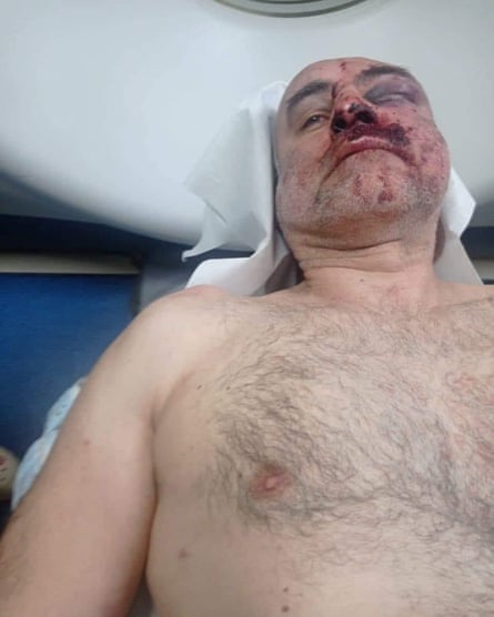 David Katsarava lying on back in hospital with injuries to his face and a black eye