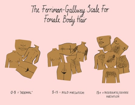 The Ferriman-Gallwey scale for the measure of hirsutismIllustration: Mona Chalabi