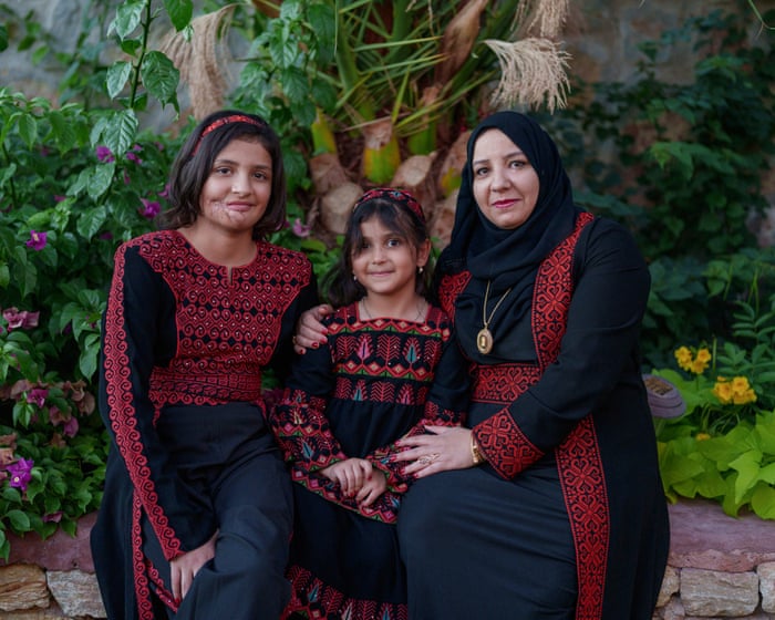 At 12 an Israeli missile ‘ripped off’ her face. Now Mazyouna is safe in the US – but not all the scars have healed