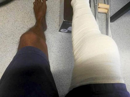Abdikaldeawe Abdisalam, a Somalian asylum seeker, with his badly swollen leg