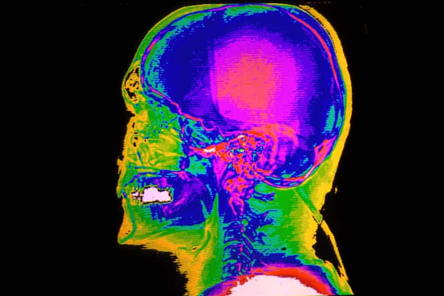 Color CAT scan of the lateral skull