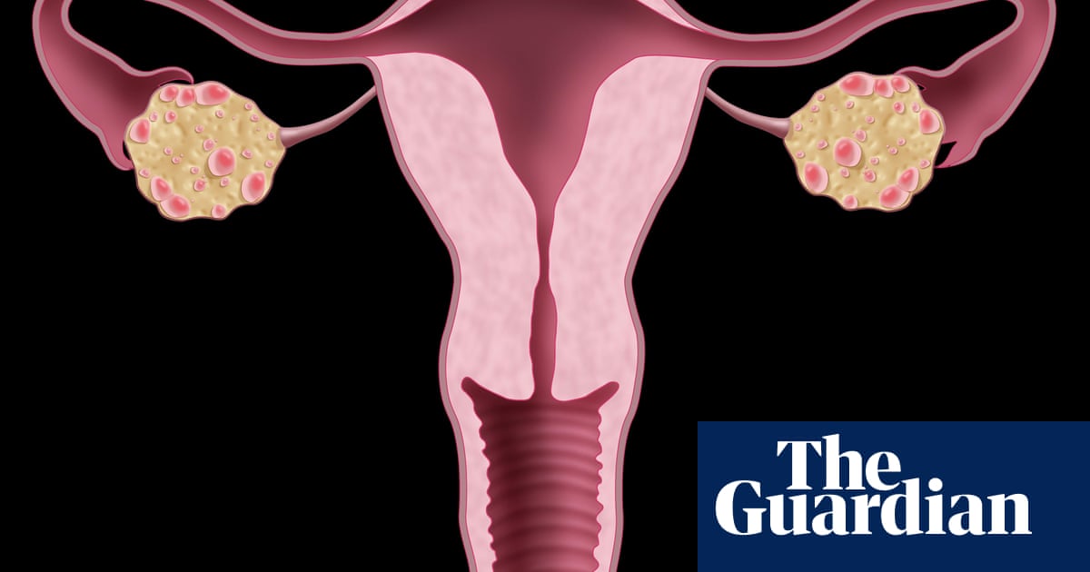 Living with polycystic ovary syndrome can be difficult and lonely | Letters