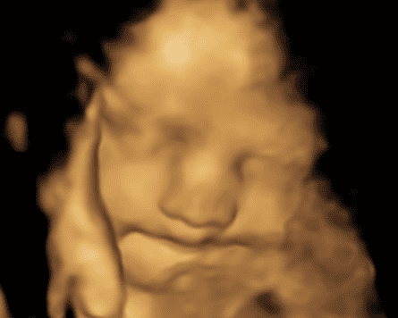 Ultrasound image of foetus with contented expression