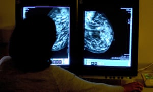 A consultant studying a mammogram