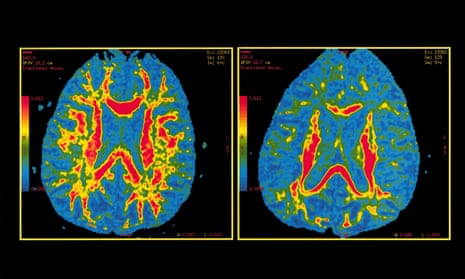 A brain with probable Alzheimer’s disease (right, compared to normal brain on left) can safely reached with ultrasound. 
