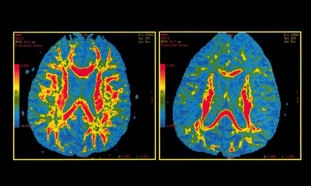 Diffusion Tensor MRIshowing a normal brain on the left and a brain probably affected by Alzheimer’s disease on the right. 