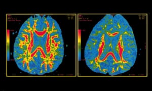 Could Modified Alzheimers Drug Treat >> The Long Difficult Search For A Drug To Treat Alzheimer S Could Modified Alzheimers Drug Treat >> The Long Difficult Search For A Drug To Treat Alzheimer S