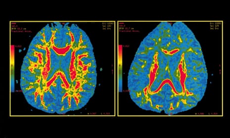 Scans of a healthy brain (left) and one with suspected Alzheimer’s disease (right), made by the Pitie Salpetriere hospital in Paris.