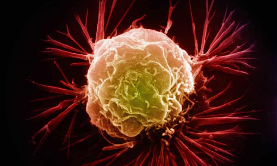 Scanning electron micrograph of a breast cancer cell.