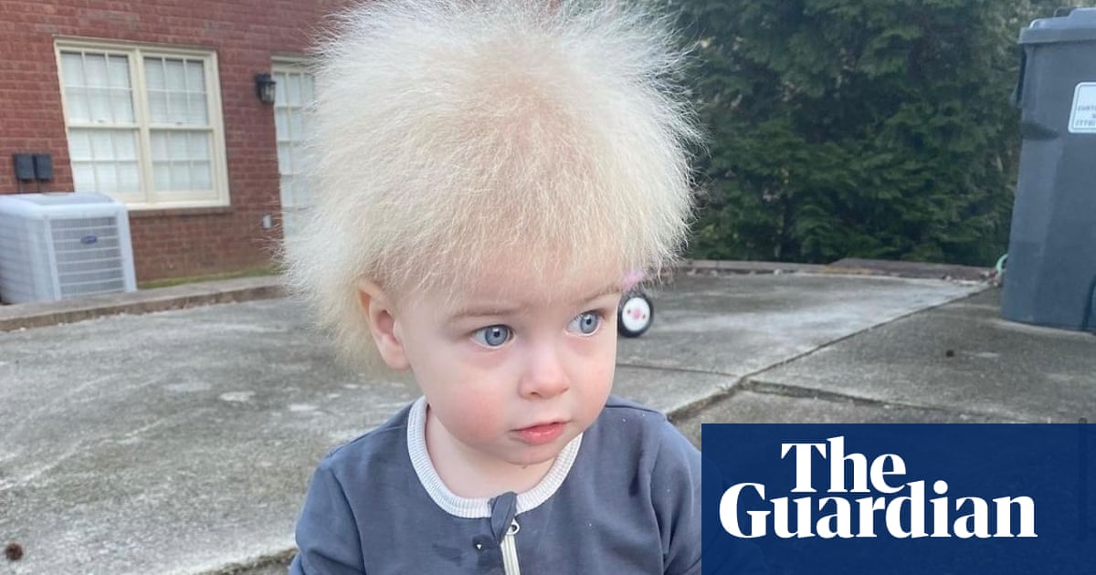 US boy with uncombable hair syndrome becomes Instagram hit