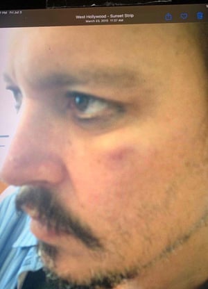 Bett accepted that the photograph did not show any injuries that Depp allegedly suffered in April 2016.