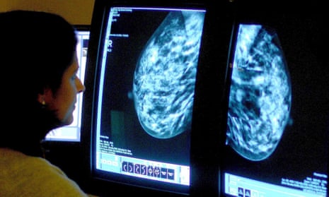 Doctor examining breast scan